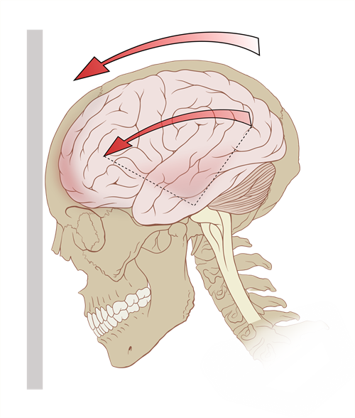 Concussion Image 